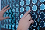 Изкуствен интелект откри 55 пропуснати от лекарите мозъчни аневризми