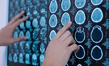 Изкуствен интелект откри 55 пропуснати от лекарите мозъчни аневризми