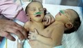 14-годишно момиче роди сиамски близнаци